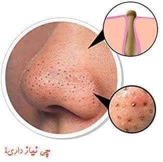 ماشین شش کاره جوش صورت و خال های سر سیاه