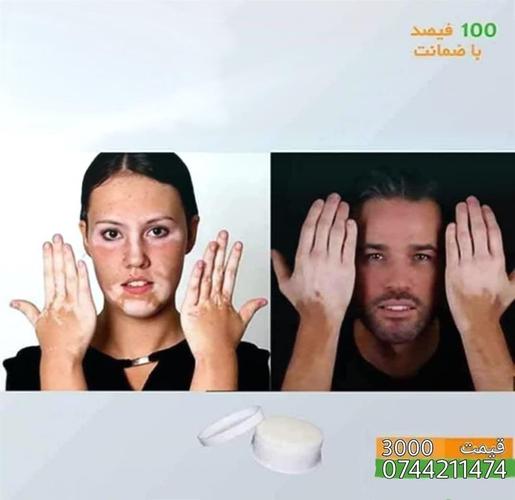 مرهم ترکیبی مخصوص لکه های سفید