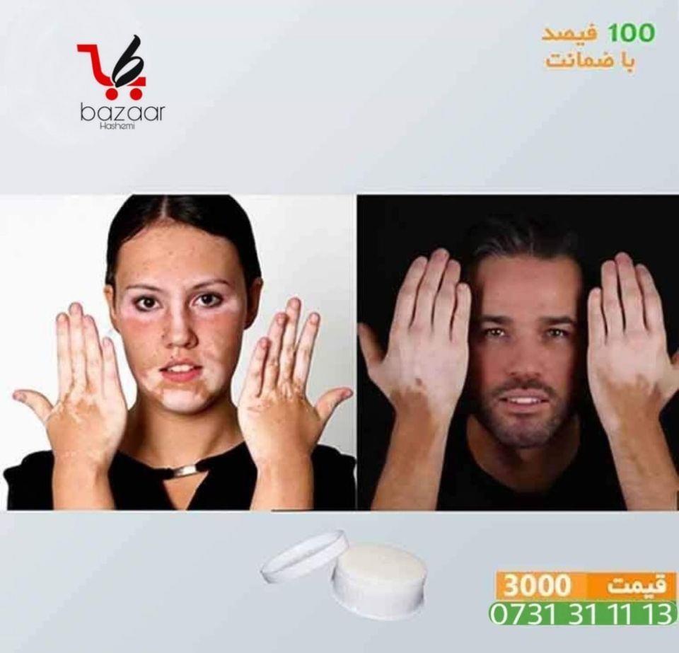 تداوی-لکه-پیس-با-ضمانت