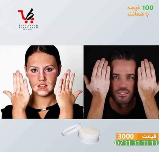 تداوی لکه پیس با ضمانت
