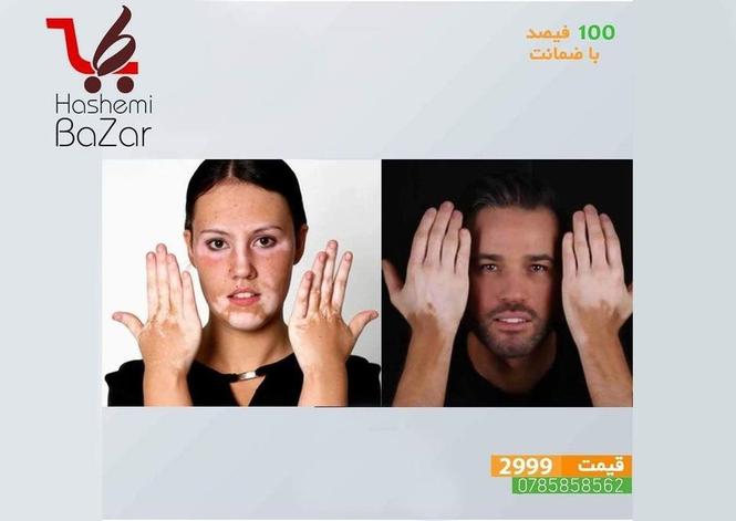 مرهم ترکیبی مخصوص لکه های سفید