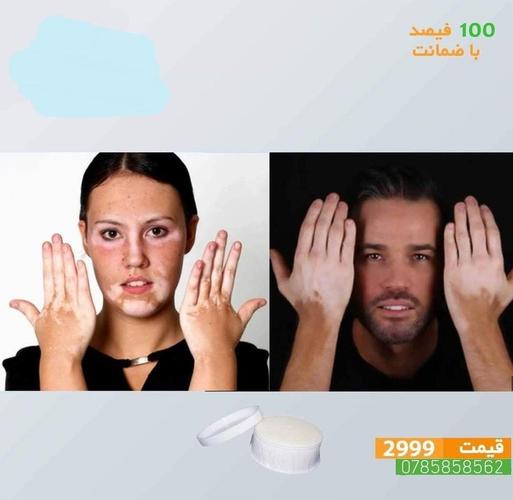 تداوی لکه سفید