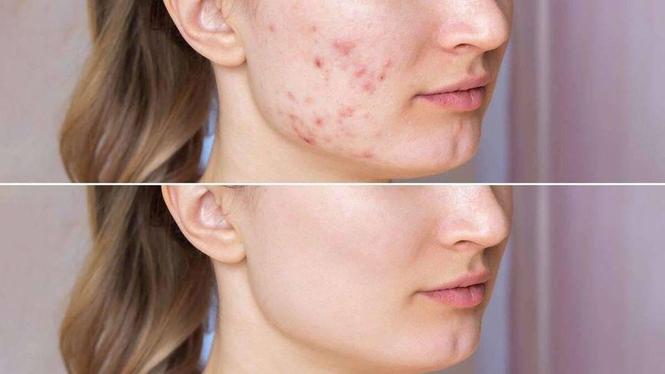 دیگر با بخارها و جوانی دانه خداحافظی کنید 0781284744