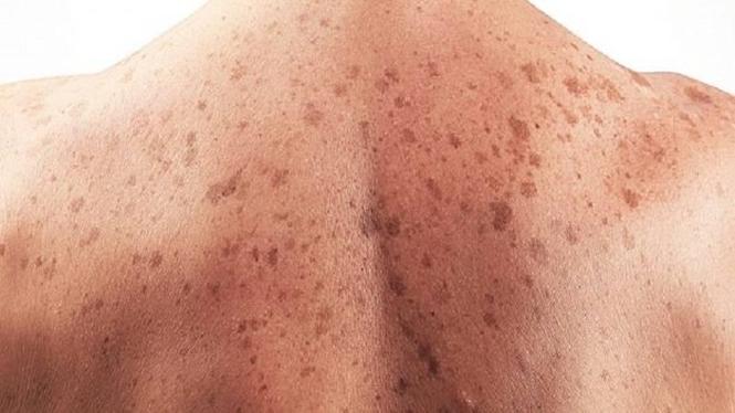 آیا از لکه های سیاه صورت، لکه بخار و سیاهی جلد خسته شده اید؟