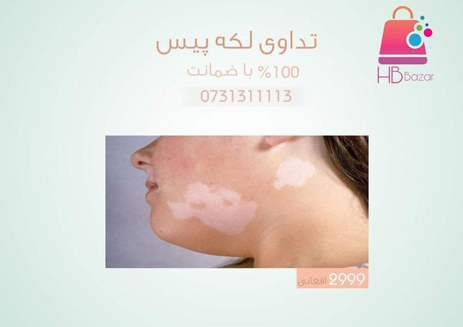 تداوی لکه های پیس