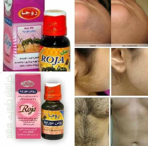 روغن مورچه بهترين محصول براى از بين بردن موهاى زائد بدن