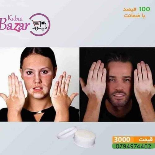 مرهم ترکیبی مخصوص لکه های سفید و یا پیس 100%باضمانت و تضمینی