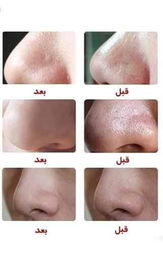 مکنده یا ساکشن برای پاکسازی صورت از بخار و چربی...0785220333