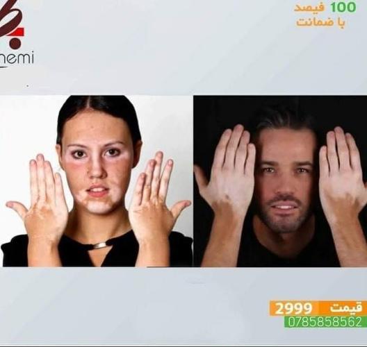 مرحم ترکیبی