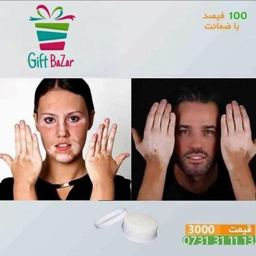 تداوی لکه سفید