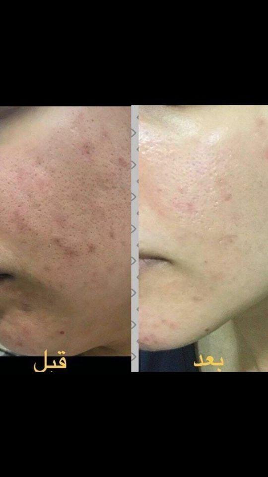 پاک-کن-لدورا