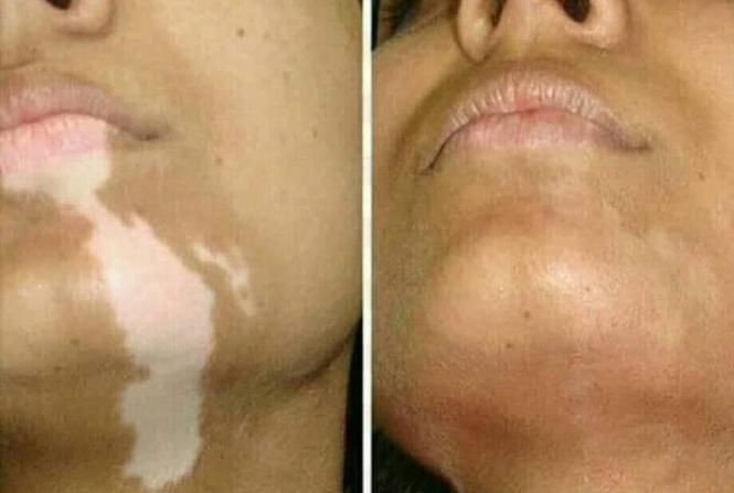 برای لکه های سفید(پیس) تداوی دایمی. ادرس: گلبهار سنتر منزل ت