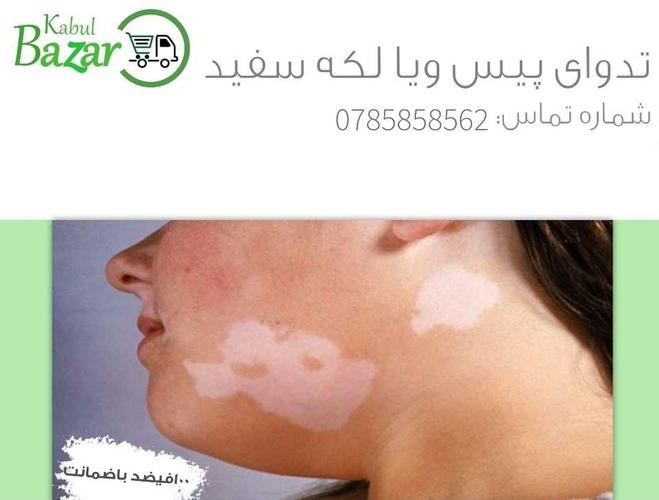 تداوی لکه سفید