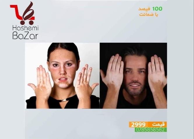 مرهم ترکیبی مخصوص لکه پیس