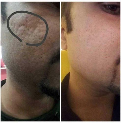 لیفتینگ برای جوان سازی صورت و گردن لدورا