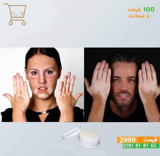 کریم گیاهی برای درمان لکه های سفید