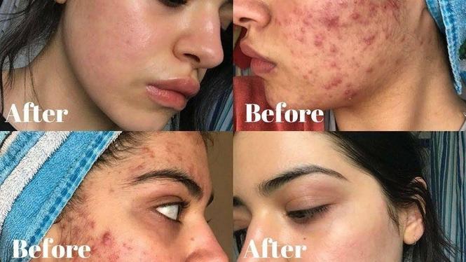 کریم %100 تضمینی از بین برنده بخار و جوانی دانه و ... 078128