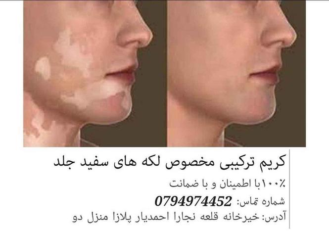 مرهم ترکیبی مخصوص لکه های سفید و یا پیس 100%باضمانت و تضمینی
