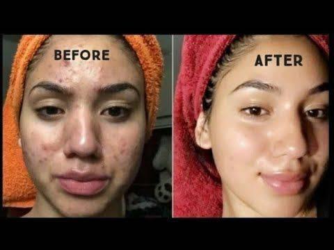 کریم %100 ضمانتی از بین برنده جوانی دانه و بخار 078128474