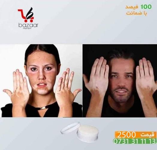 مرهم ترکیبی مخصوص لکه های سفید جلد